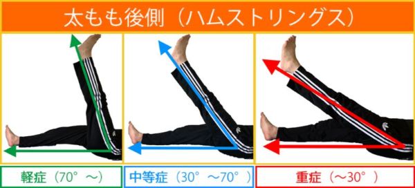 肉離れimg